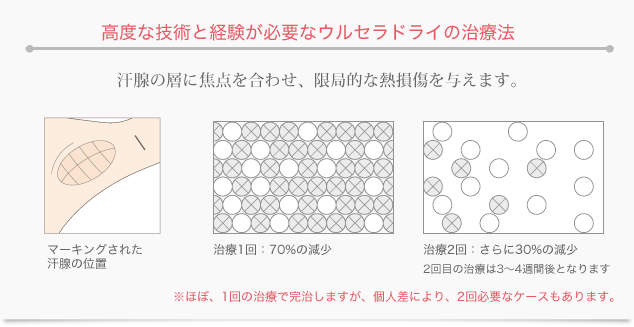 高度な技術と経験が必要なウルセラドライの治療法