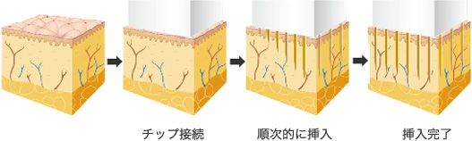 マイクロニードル挿入の流れ